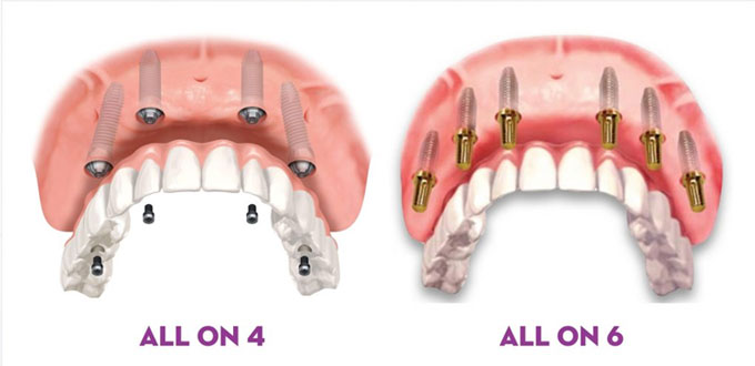 dich-vu-implant-uy-tin dich-vu-implant-uy-tin Đặt Implant tức thì sau nhổ răng dich vu implant uy tin