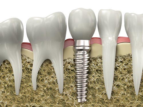cam-ghep-implant-1 cam-ghep-implant-1 Home cam ghep implant 1