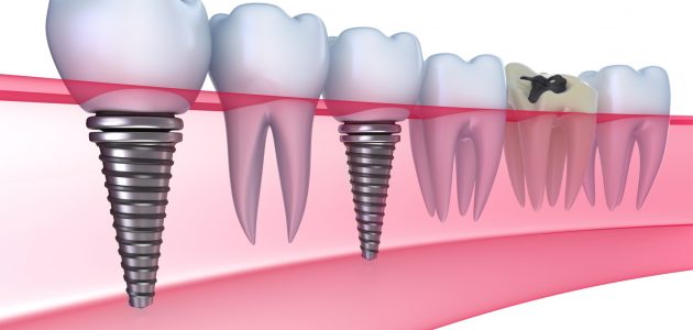 implant-rang-uy-tin-hcm-630x300 implant-rang-uy-tin-hcm-630x300 trồng răng Implant không đau Cấy răng Implant ở đâu tốt và uy tín? implant rang uy tin hcm 630x300