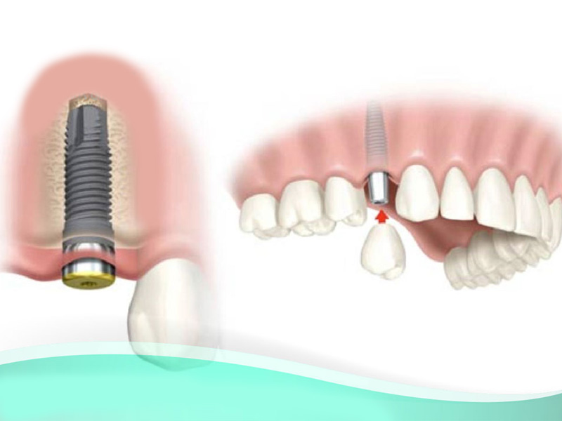 sai-gon-implant-10 sai-gon-implant-10 Cấy răng implant có đau không trong suốt quá trình ghép răng implant CÓ ĐAU HAY KHÔNG, CÓ “ẢNH HƯỞNG” KHI THỰC HIỆN PHƯƠNG PHÁP CÂY RĂNG IMPLANT? sai gon implant 10