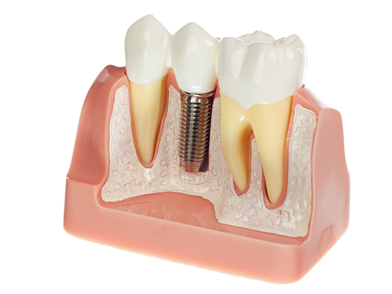 sai-gon-implant-14 sai-gon-implant-14 Implant răng hàm là một hình thức cấy ghép răng hàm tiên tiến Bạn đã thực sự hiểu về cấy ghép implant răng hàm? sai gon implant 14