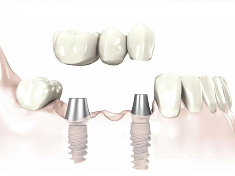 sai-gon-implant-2 sai-gon-implant-2 Implant giờ đây là một thuật ngữ chẳng còn xa lạ với rất nhiều khách hàng Mất răng là trường hợp cần thiết để thực hiện cấy ghép implant sai gon implant 2