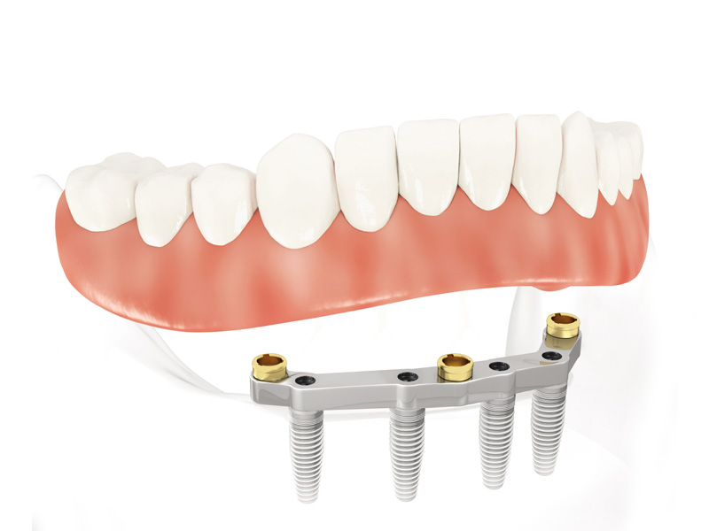 sai-gon-implant-28 sai-gon-implant-28 Nha khoa quốc tế khẳng định cấy ghép implant là bước tiến vượt bậc trong lĩnh vực nha khoa NHỮNG LƯU Ý KHI CẤY GHÉP IMPLANT MÀ BẠN CẦN BIẾT sai gon implant 28