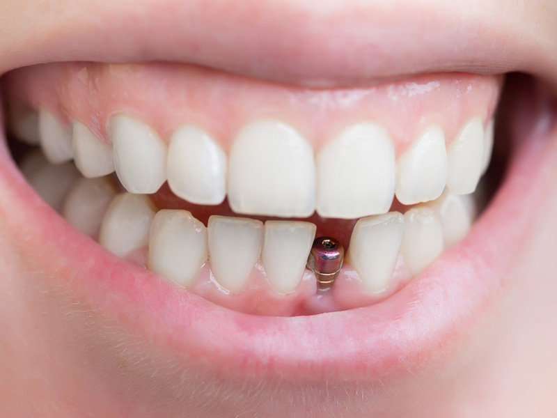 sai-gon-implant-29 sai-gon-implant-29 Ghép răng Implant và cầu răng đều là hai phương pháp giúp thay thế răng đã mất Sự khác nhau giữa cấy ghép implant và ghép cầu răng là gì? sai gon implant 29