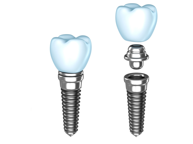 sai-gon-implant-9 sai-gon-implant-9 Nguyên vật liệu cấy ghép có gây dị ứng sau khi trồng răng implant sai gon implant 9