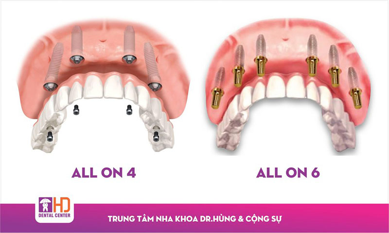 Cay ghep rang implant uy tin chat luong tai HCM