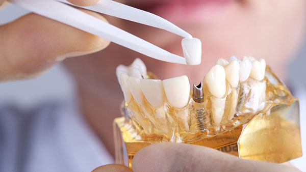 dental-implants-03 dental-implants-03 Dấu hiệu bệnh lý cơ bản dẫn đến việc mất răng và phải cấy răng implant Dấu hiệu bệnh lý cơ bản dẫn đến việc mất răng và phải cấy răng implant dental implants 03