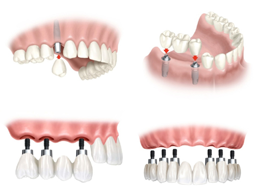 Yeu to nao anh huong den chat luong cay ghep rang Implant