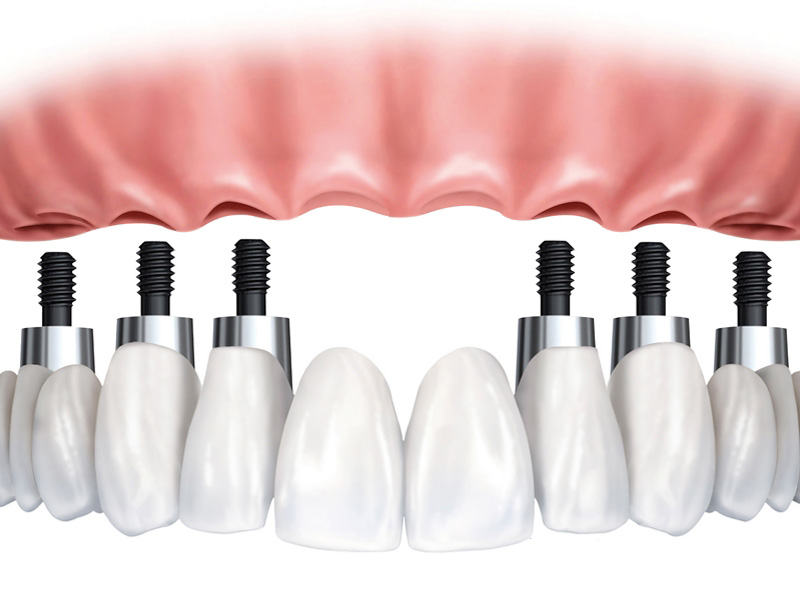 dental-implant-40 dental-implant-40 Khám phá công dụng tích cực của trụ răng giả implant trên vùng răng bị mất Trụ răng implant nằm trong cơ thể sẽ có vấn đề gì không dental implant 40