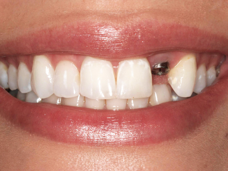 dental-implant-41 dental-implant-41 Những ảnh hưởng khi bị mất/hư răng cửa KHI BỊ MẤT/HƯ RĂNG THÌ ĐÂU MỚI LÀ GIẢI PHÁP HỮU HIỆU NHẤT? dental implant 41