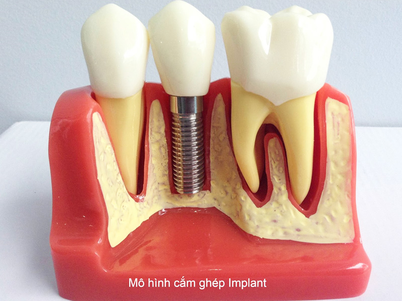 dental-implant-43 dental-implant-43 Cấy ghép implant là gì? NÊN CẤY GHÉP IMPLANT TRONG NHỮNG TRƯỜNG HỢP NHƯ THẾ NÀO? dental implant 43