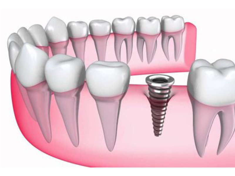 dental-implant-44 dental-implant-44 Trường hợp nào có thể thực hiện cấy ghép implant nhanh 1 ngày TRỒNG RĂNG VỚI KẾT QUẢ NHANH CHÓNG – PHƯƠNG PHÁP CẤY GHÉP RĂNG IMPLANT 1 NGÀY dental implant 44
