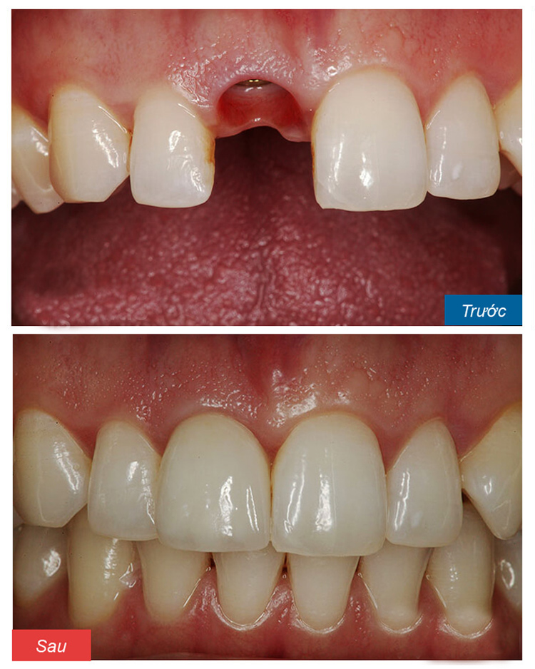 dental-implant dental-implant Thực phẩm hỗ trợ điều trị viêm tủy răng dental implant