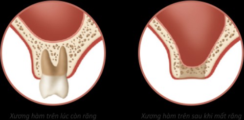 ghep-xuong-trong-cay-ghep-implant-1 ghep-xuong-trong-cay-ghep-implant-1 Tại sao chứng mất răng lại xuất hiện? ĐIỀU TRỊ CHỨNG MẤT RĂNG BẰNG CÁCH TRỒNG RĂNG IMPLANT ghep xuong trong cay ghep implant 1