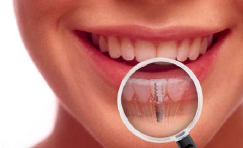 1 1 Khi nào thực hiện phương pháp cấy ghép Implant thì cho hiệu quả cao nhất? KHI NÀO THỰC HIỆN PHƯƠNG PHÁP CẤY GHÉP IMPLANT LÀ PHÙ HỢP? 1