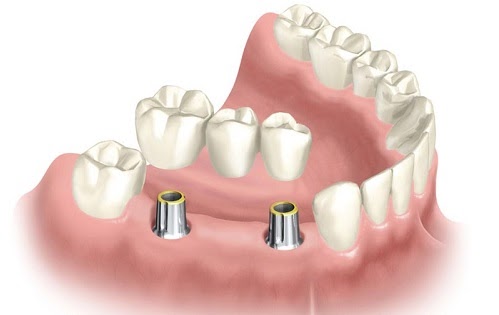 2 2 Xương hàm là yếu tố gây sức ảnh hưởng lớn đến cấy ghép implant Đâu là yếu tố ảnh hưởng nhiều nhất đến cấy ghép implant? 2