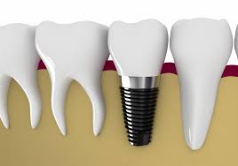 7 7 Răng Implant giống như răng thật, có cả thân răng và chân răng Sau khi cấy răng implant bạn cần lưu ý những điều này 7