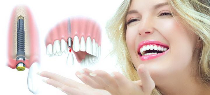 9 9 Với phương pháp cấy ghép Implant, công nghệ tốt nhất mà các nha sỹ chọn là áp dụng Ghép răng Implant 4S Tuổi thọ thân răng kéo dài hơn nhờ phương pháp làm cầu răng sứ 9
