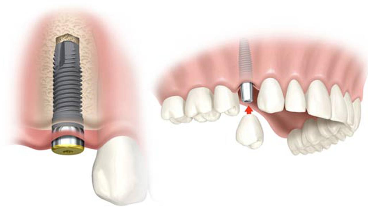cay-implant-3 cay-implant-3 Thay đổi ngoại hình hoàn hảo bằng cách trồng răng sứ implant cay implant 3