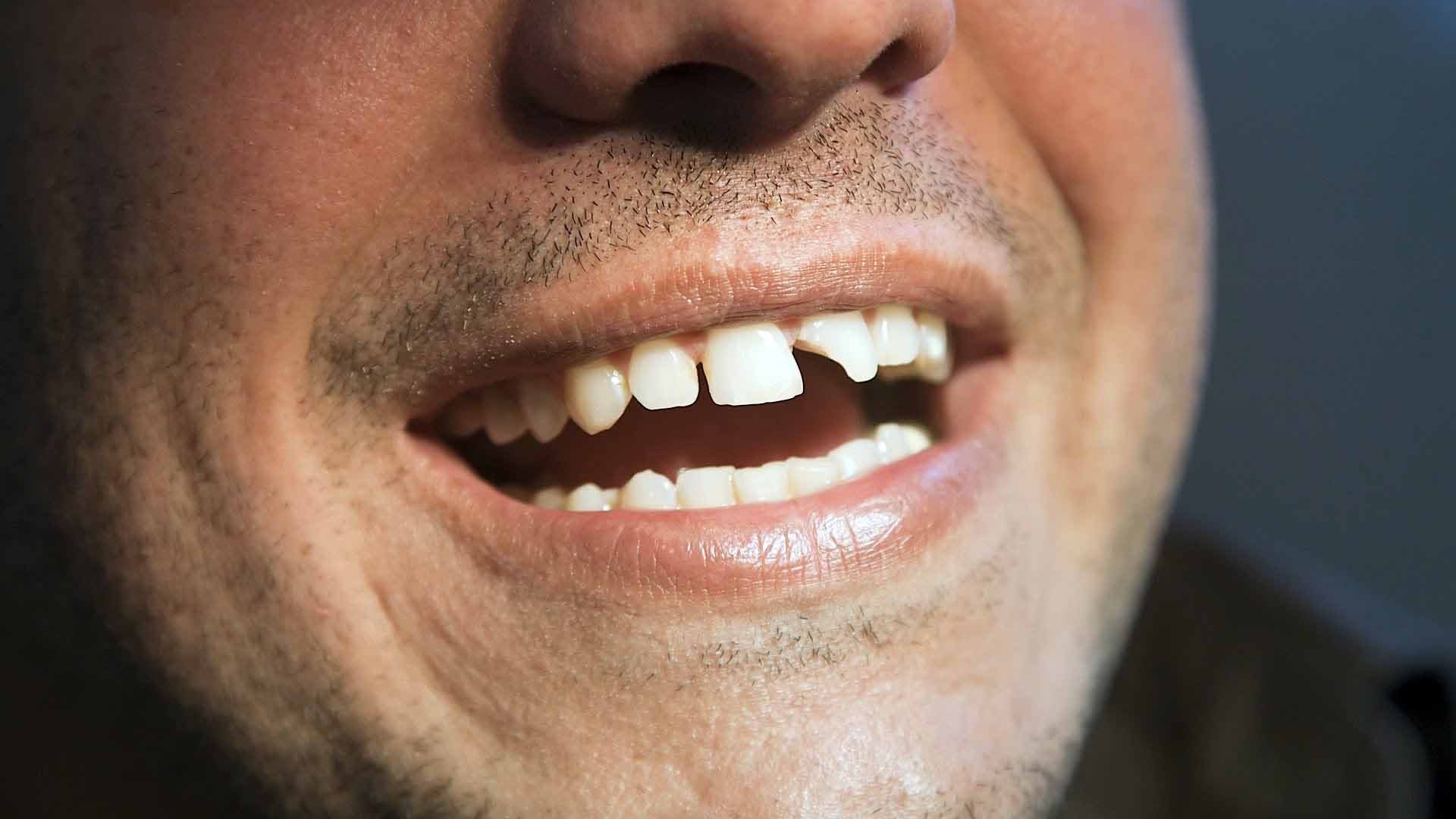 gay-rang-cua-ham-tren-3432 gay-rang-cua-ham-tren-3432 NÊN CẤY GHÉP IMPLANT KHI NÀO? gay rang cua ham tren 3432