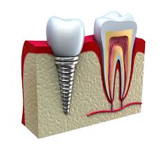 images images CẤY GHÉP IMPLANT CHO RĂNG HÀM – ĐAU HAY KHÔNG? images