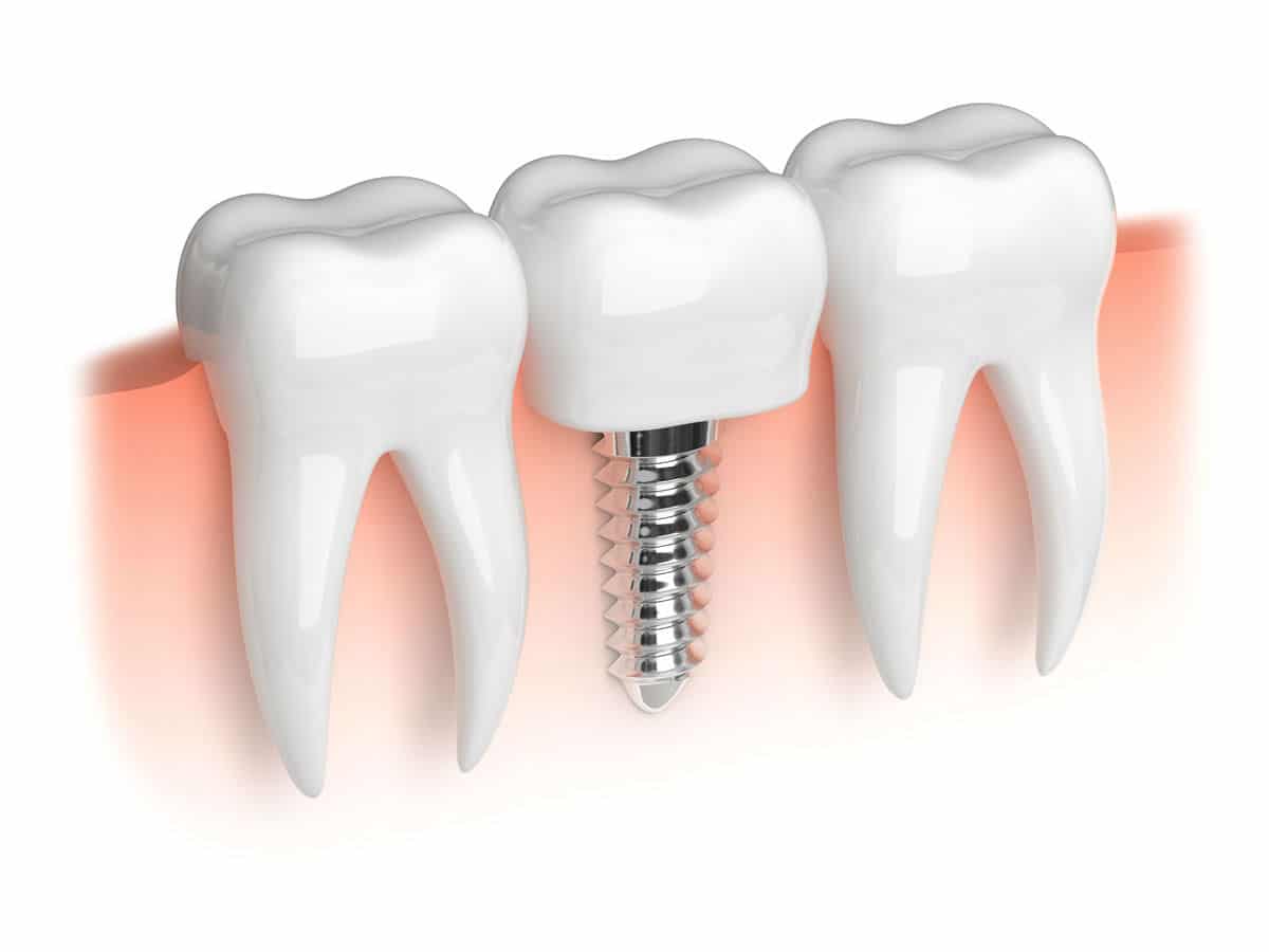 implant-61 implant-61 Thời điểm “Vàng” để thực hiện trồng răng implant implant 61