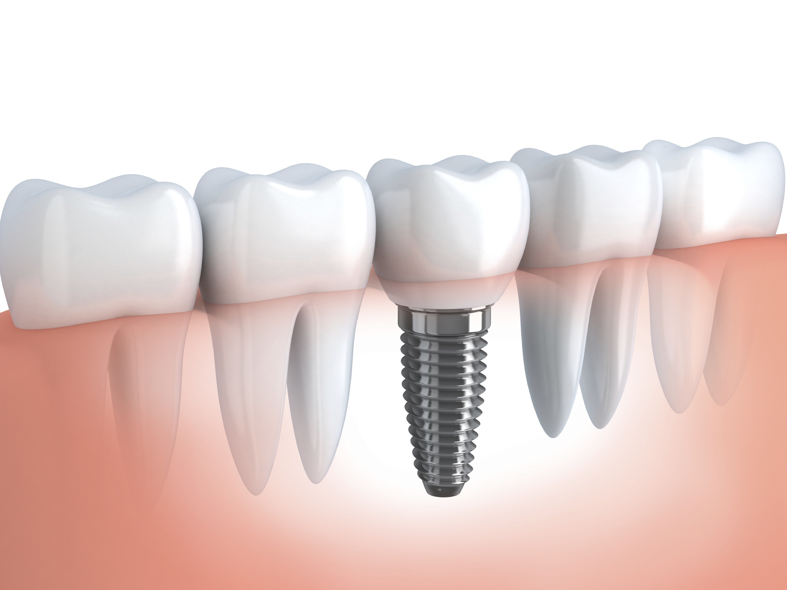 lam-rang-implant-1 lam-rang-implant-1 Điều gì tác động đến kết quả trồng răng implant lam rang implant 1