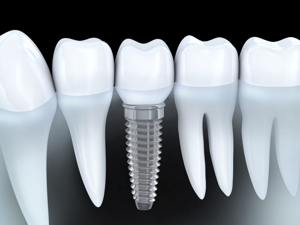 tong-quat-ve-implant-nha-khoa-phuc-hinh-rang-nhanh-chong7-1 tong-quat-ve-implant-nha-khoa-phuc-hinh-rang-nhanh-chong7-1 Cấy ghép implant giúp phục hình khi mất răng rất hiệu quả Điều kiện phục hình hàm răng tức thì bằng phương pháp cấy ghép implant tong quat ve implant nha khoa phuc hinh rang nhanh chong7 1