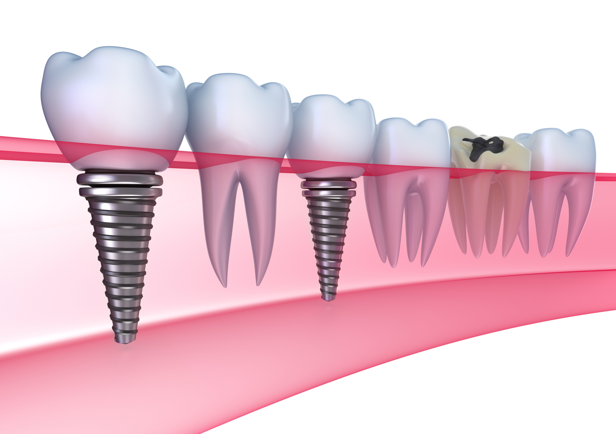 viem-chan-rang-implant viem-chan-rang-implant Tại sao trồng răng implant thành công nhưng về sau lại bị lung lay? viem chan rang implant